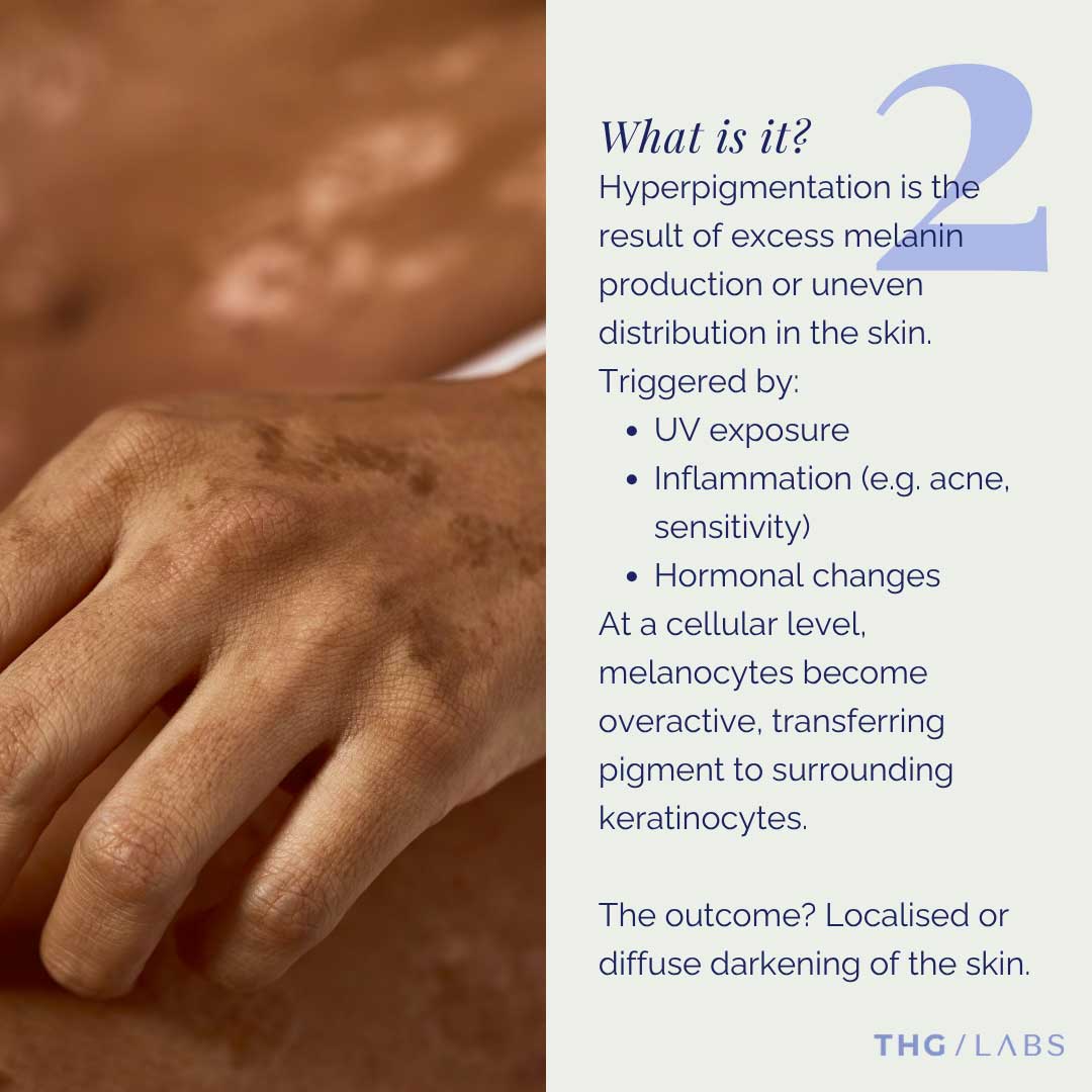 Close-up skin imagery illustrating hyperpigmentation caused by UV exposure, inflammation and uneven melanin production in skincare science